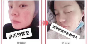 敏感肌肤如何护理？紧致修护敏感肌肤首选悦蕾冰泉焕颜蚕丝面膜